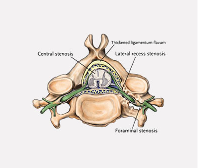 Spinal Stenosis